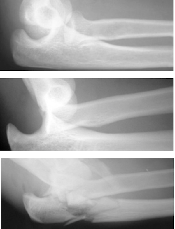 Elbow dislocation